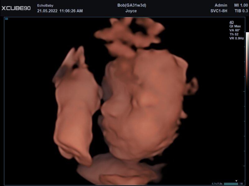 3D echofoto 31 weken