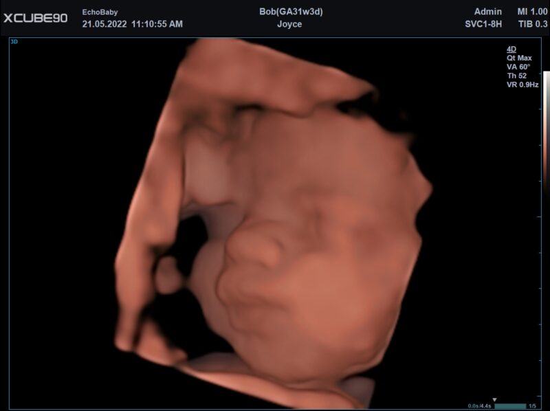 3D echofoto 31 weken