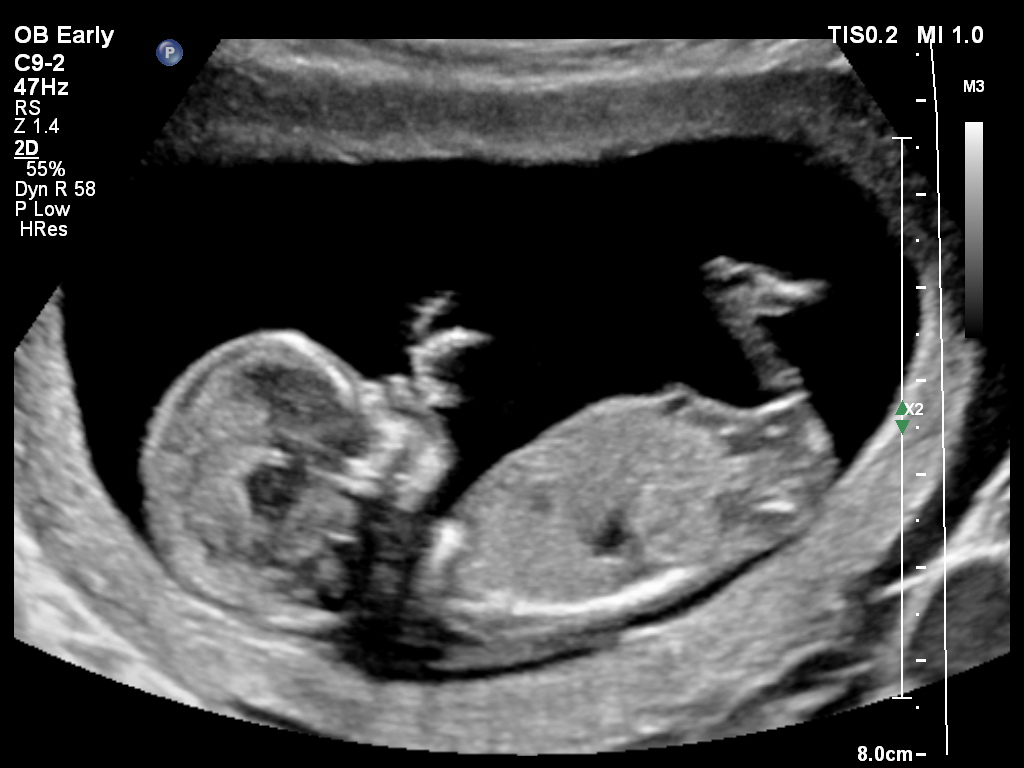 Geslacht baby. Vanaf wanneer kan je dat weten?